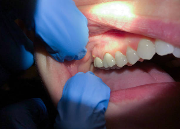 Best Emergency Treatment for Dental Infections or Abscesses in Fergus Falls, MN