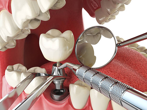 Best Emergency Gum Treatment in Fergus Falls, MN